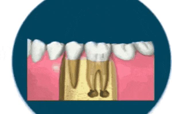大牙戴牙冠能用多久