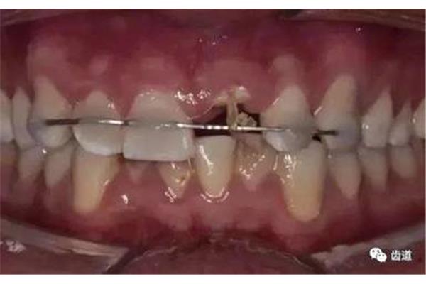 牙套如何固定在牙齒上,矯正牙簧需要多長時間?