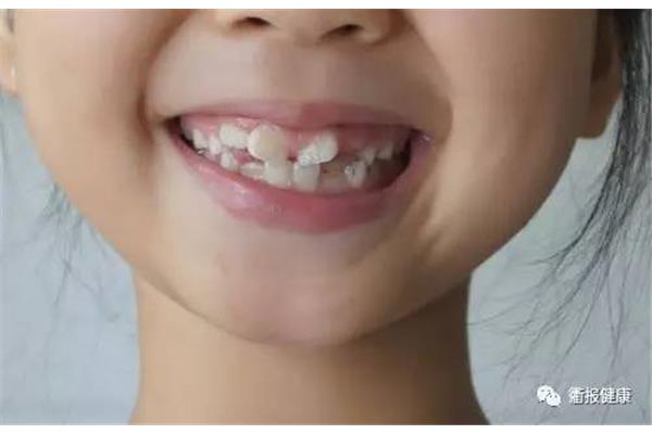 孩子矯正門牙,10歲孩子門牙突出可以矯正嗎?