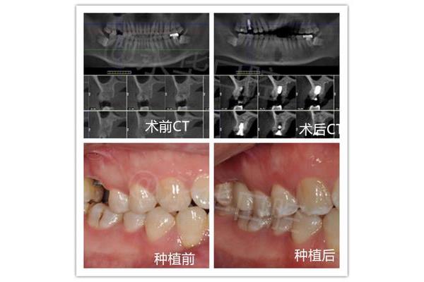 更換的假牙和安裝的假牙能使用多久?