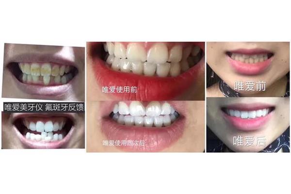 牙齒美白多少錢,能持續多久,牙齒美白多少錢?