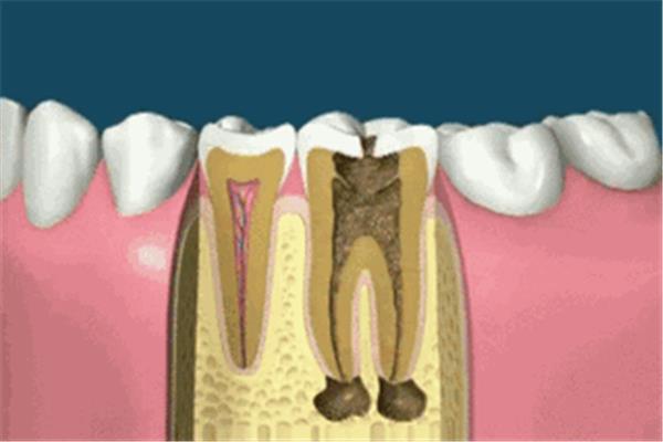 有神經殺傷的牙齒能堅持多久?神經殺死后牙齒能堅持幾年?