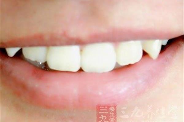 在上海補一顆牙需要多長時間?樹脂補牙能堅持多久?