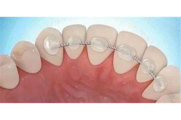 固定器鋼絲在齒位鋼絲矯正牙齒需要多長時間?