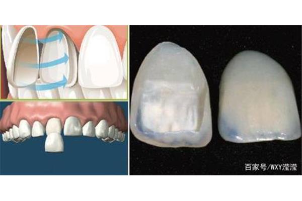 陶瓷貼片牙和全陶瓷貼片牙能堅持多久?