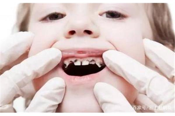 小孩補一次牙能堅持多久