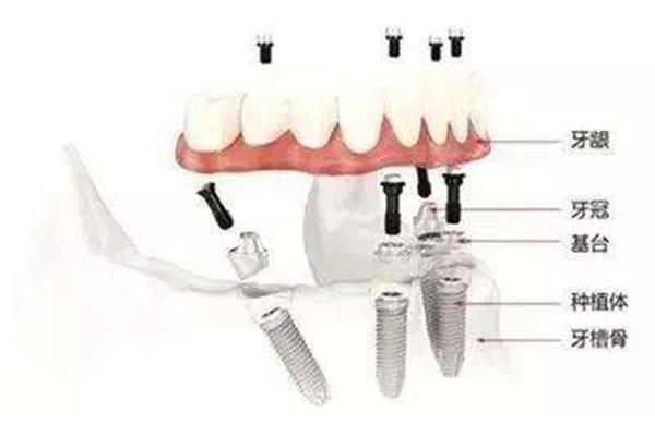 種植牙植骨后二期手術需要多久,種植牙需要多久?