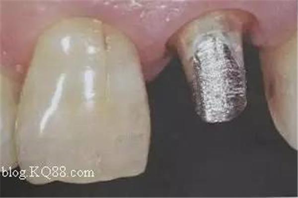 牙齒鑄造樁能用多久