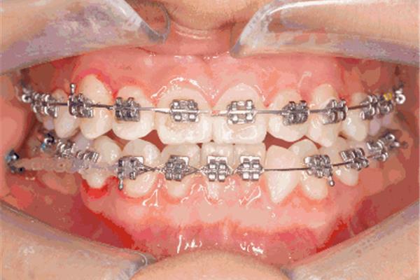 成年人矯正牙齒需要多久,牙套矯正牙齒需要多久?