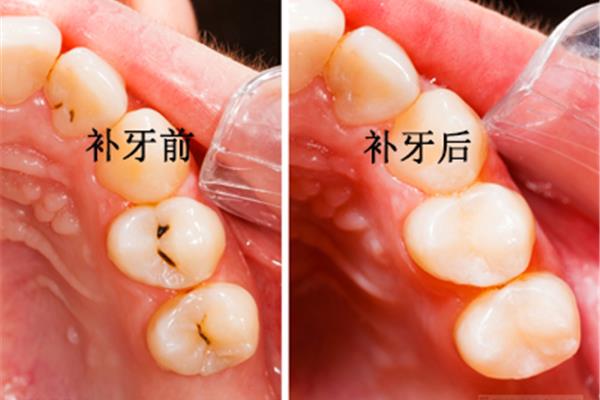 一次性補牙能堅持多久,一次性補牙材料能堅持多久?