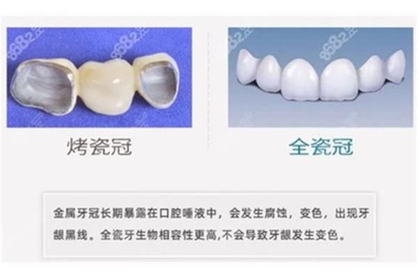 醫院做烤瓷牙多少錢?上海做烤瓷牙醫院