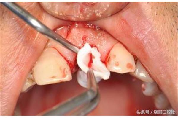 拔牙后多久會出血?拔牙后出血多少是正常的?