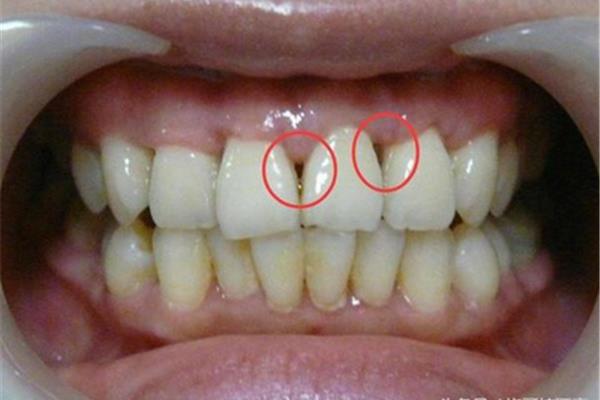 牙齦萎縮的原因是什么?什么原因導致牙齦萎縮?