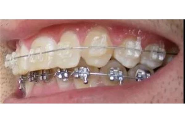 矯正牙齒咬合需要多久,成年人矯正牙齒需要多久?