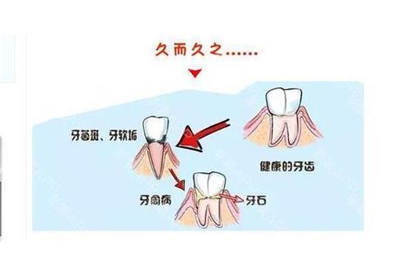 拔牙后需要多長時間恢復,牙神經痛拔牙后需要多長時間恢復?