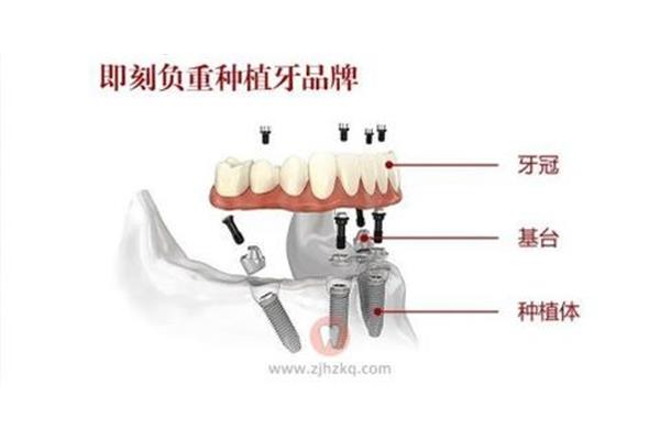 種牙一般需要多長時間?種植牙半顆牙需要多久?