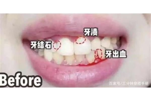 牙齒流血多久,牙齒不流血多久?