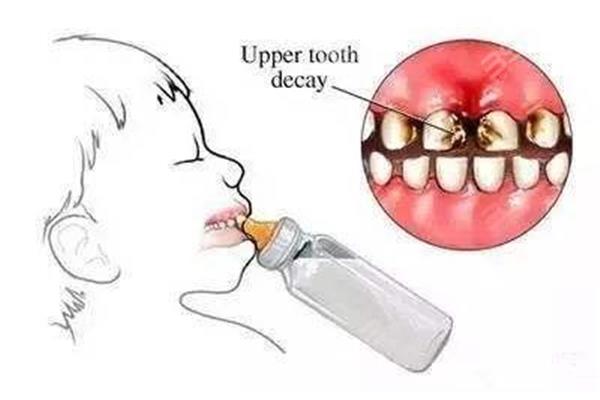 牙齒空洞修補需要多久