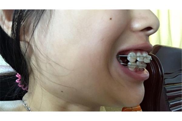 種植支抗后的注意事項,劉雯牙齦釘的原因是什么?