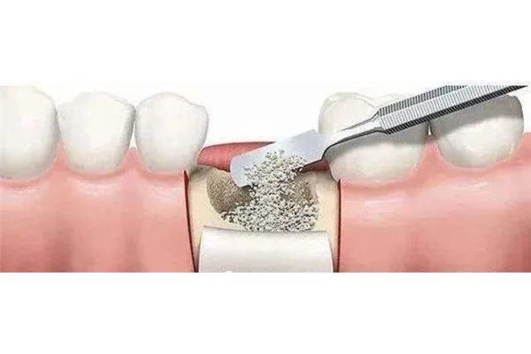 下頜骨植骨后多久可以種牙?種牙一般需要多長時間?