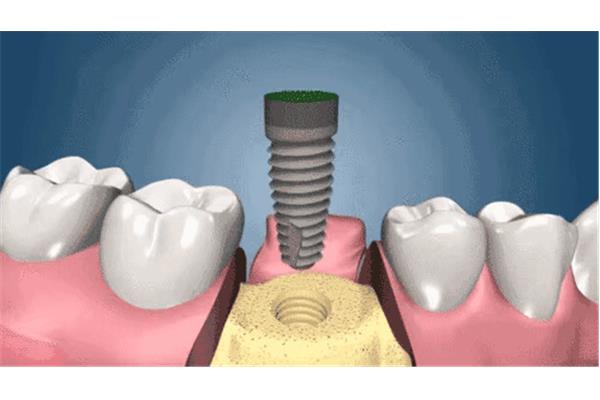 牙槽骨移植能植入多久,切牙骨移植能植入多久?