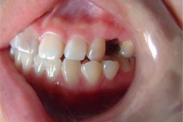 牙齒植骨多久鑲牙