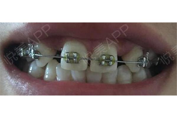 牙齒箍好后矯治器戴多久,用牙套矯正牙齒要多少錢?