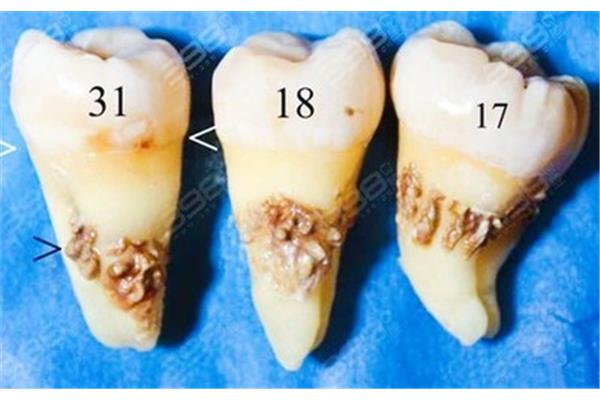 拔完牙多久可以做牙周手術