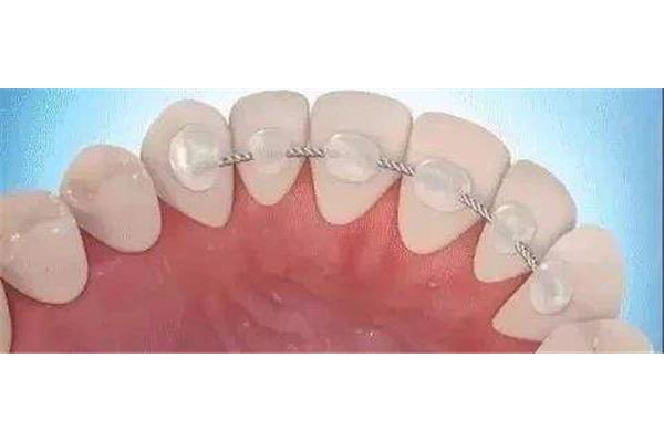 做一個牙齒固位體需要多久,戴一個固位體需要多久?