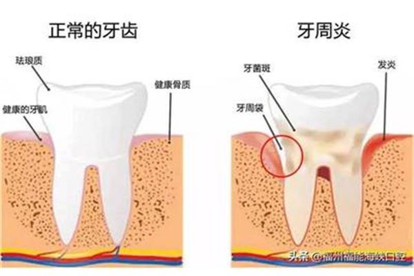 嵌體固定牙和全瓷固定牙可以用幾年?