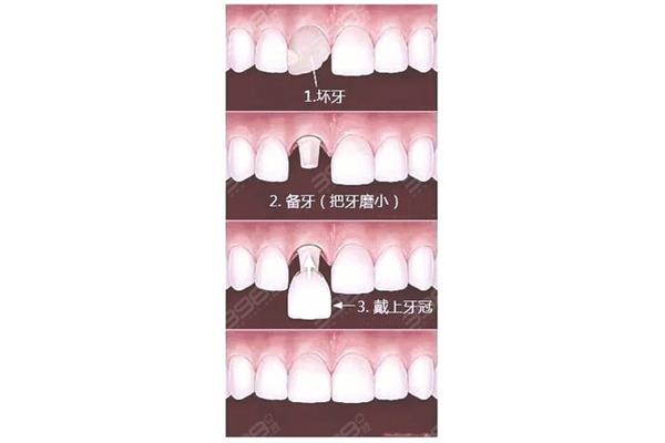 裝一副假牙需要多長時間,一副假牙多少錢?