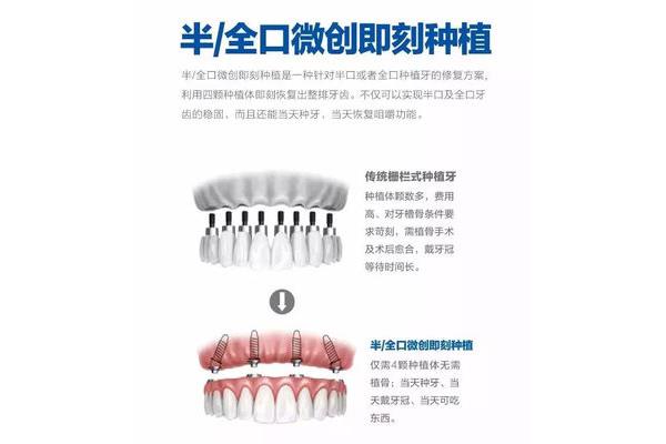 做半口種植牙需要多久,做種植牙手術需要多久?