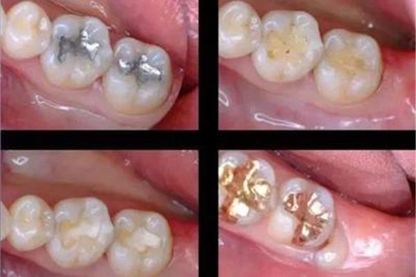 高嵌體填充能堅持多久?瓷嵌體補牙能堅持多久?