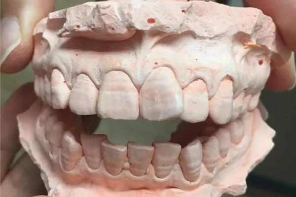 根管治療咬牙模要多久,什么時候需要根管治療?