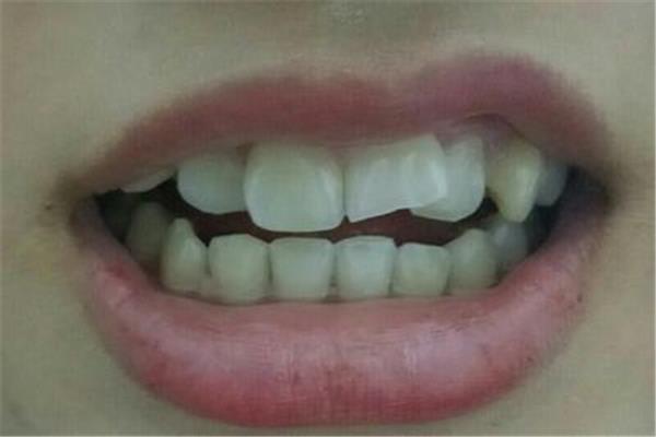 乳牙掉了多久了?長新牙很正常,孩子掉牙的年齡和順序