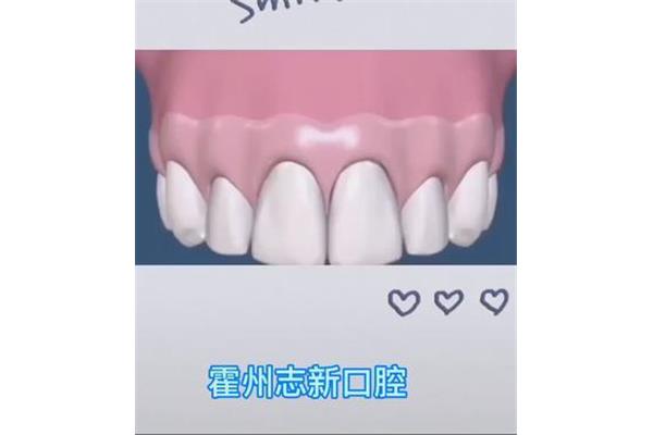 門牙缺失多久種植牙