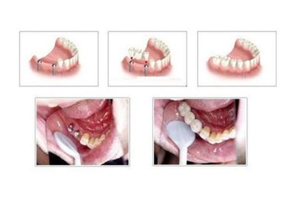牙齒脫落后多久可以種牙,拔牙后多久種牙最好?