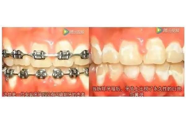 安裝牙套需要多長時間,安裝完牙套需要多長時間?