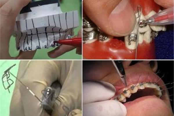 戴牙套要多久才能把牙齒排列整齊,帶牙套的牙齒能堅持多久?
