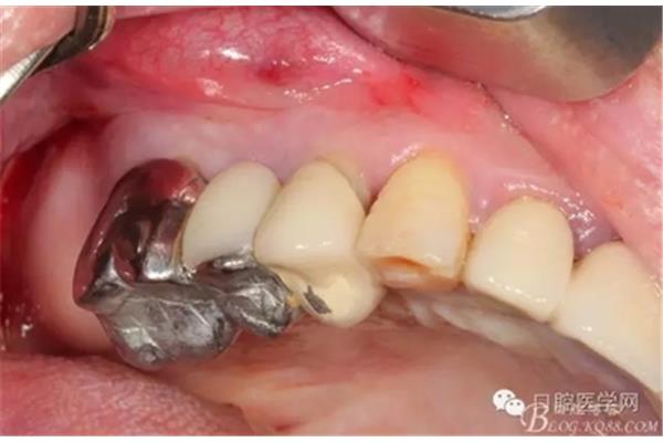 牙周炎拔牙植骨種牙要多久