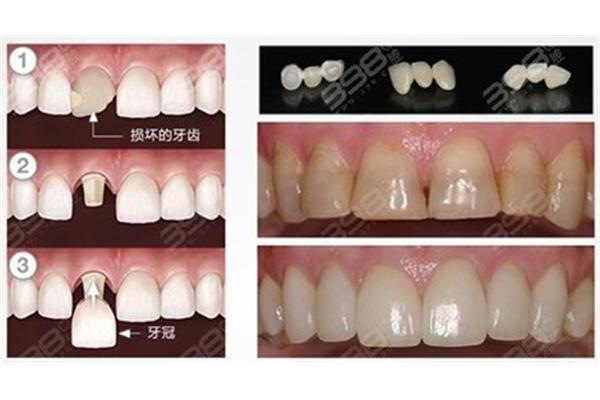 常規全瓷牙質保多久,氧化鋯全瓷牙質保多久