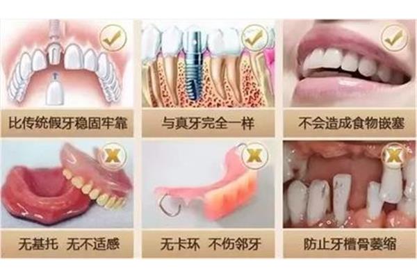 安裝假牙需要多長時間?臨時牙最多能戴多久?