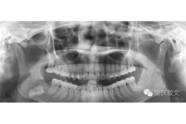 牙膜的輻射需要多長時間排出,牙膜的輻射需要多長時間消失?