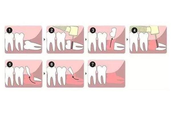 牙齒劈裂時,需要多長時間修復劈裂的種植牙?