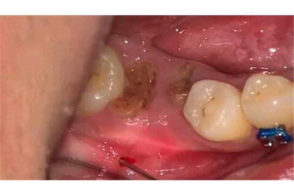 大牙拔掉后需要多久才能愈合恢復?