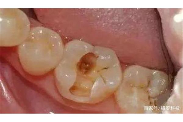 齲齒補牙后的「壽命」有多長?修復后的牙齒壽命有多久?