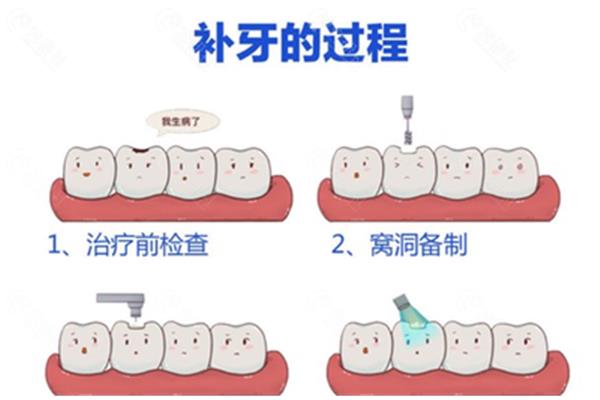 你多久去補一次牙,多久去補二次牙?