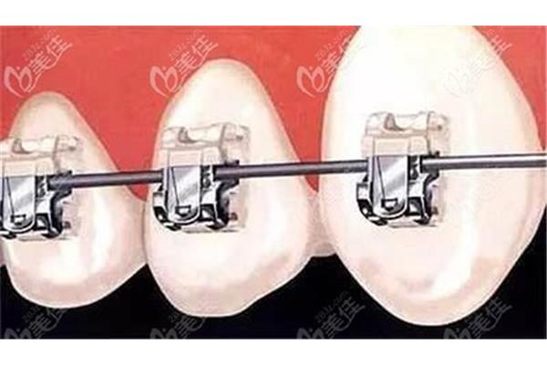 牙套固定牙齒多久?牙套下面牙疼怎么辦?