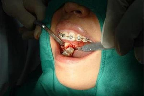 拔后磨牙和智齒后疼痛會持續多久?