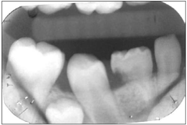 前磨牙矯正,矯正牙齒磨牙后移容易嗎?